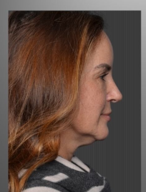 Deep plane facelift before — case 01