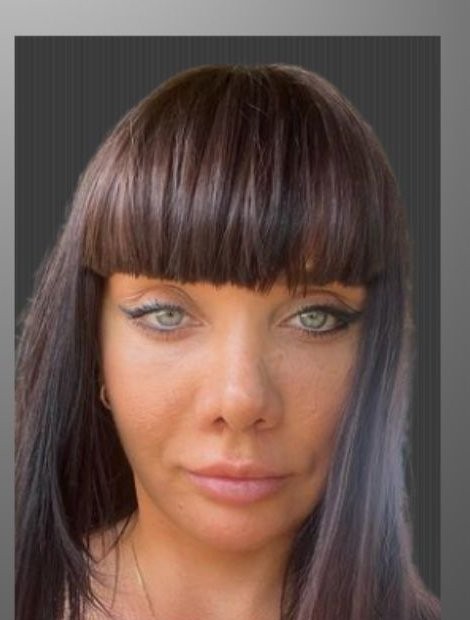 Mid-face lift and rhinoplasty after — Russia patient