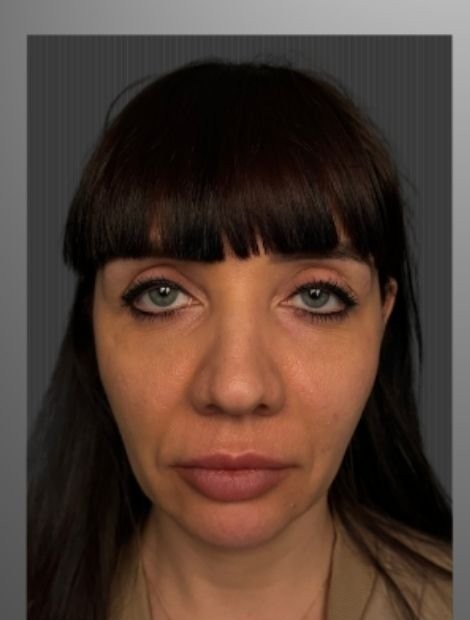 Mid-face lift and rhinoplasty before — female patient, 42, Russia