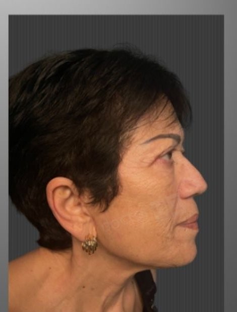 Deep plane facelift after — Germany patient, age 78