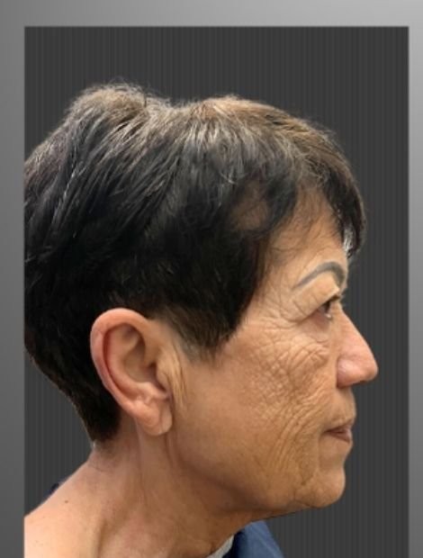Deep plane facelift before — female patient, 78, Germany