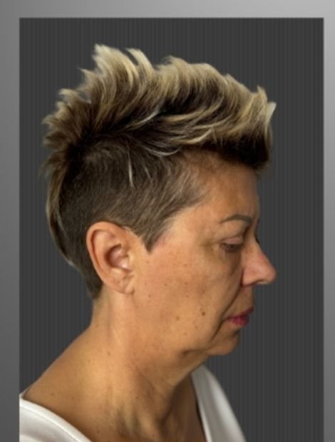 Facelift before — female patient, 60, Serbia