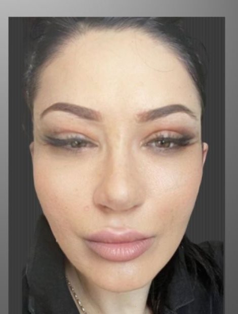 Mid-face lift and rhinoplasty after — Romania patient