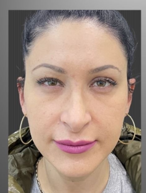 Mid-face lift and rhinoplasty before — female patient, 40, Romania