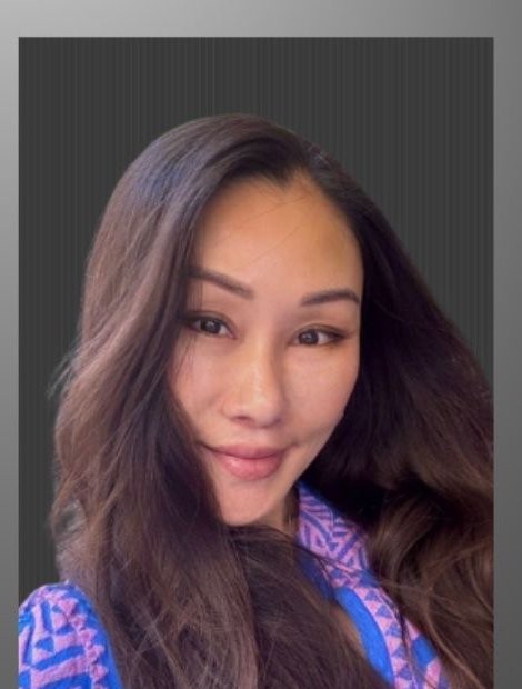 Mid-face lift and rhinoplasty after — Hong Kong patient