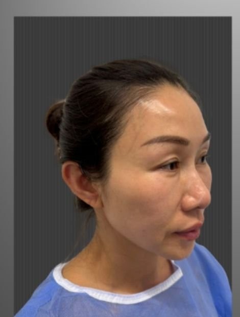 Mid-face lift and rhinoplasty before — female patient, 46, Hong Kong