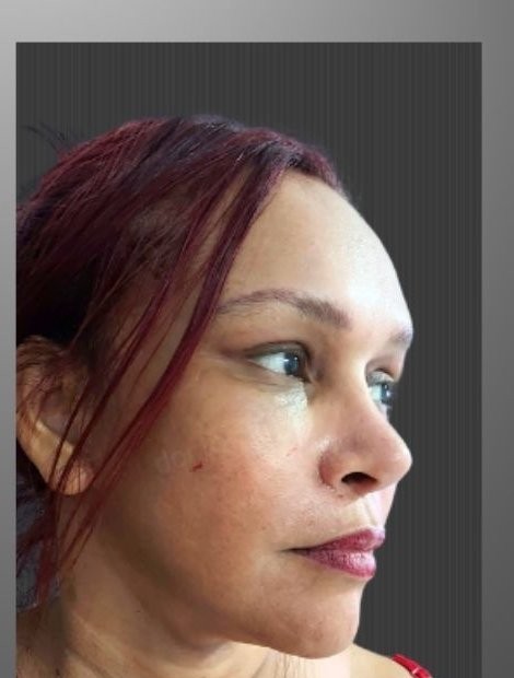 Mid-face and temple lift after — Spain patient