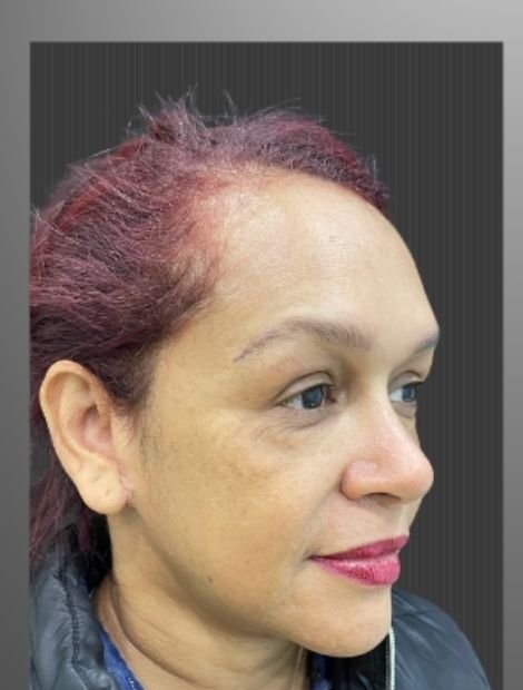 Mid-face and temple lift before — female patient, 46, Spain