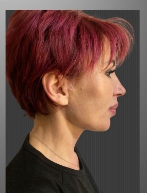 Deep plane facelift after — Ukraine patient, age 52