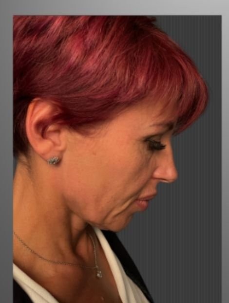 Deep plane facelift before — female patient, 52, Ukraine