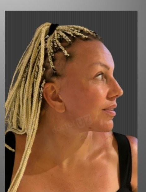 Facelift after — Serbia patient, age 46