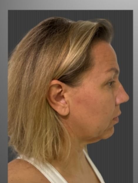 Facelift before — female patient, 46, Serbia