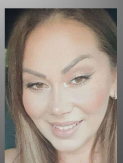 Mid-face lift and rhinoplasty after — Albania patient