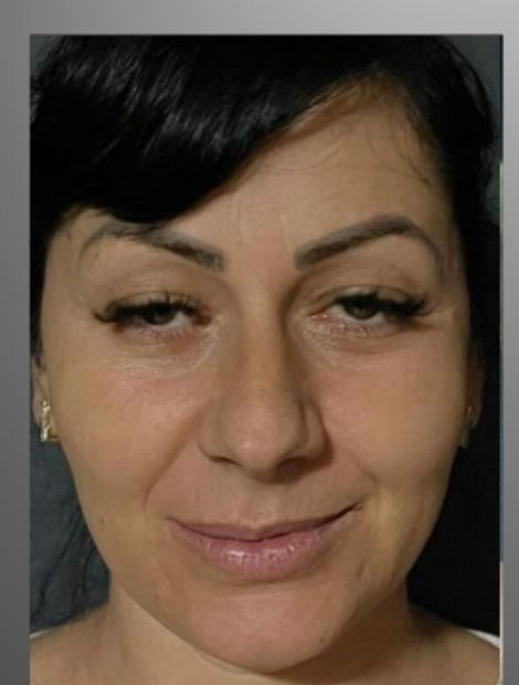 Mid-face lift and rhinoplasty before — female patient, 48, Albania