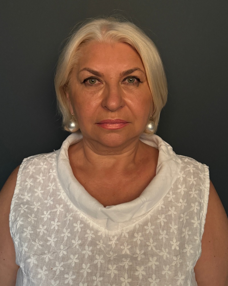 Patient before deep plane facelift surgery