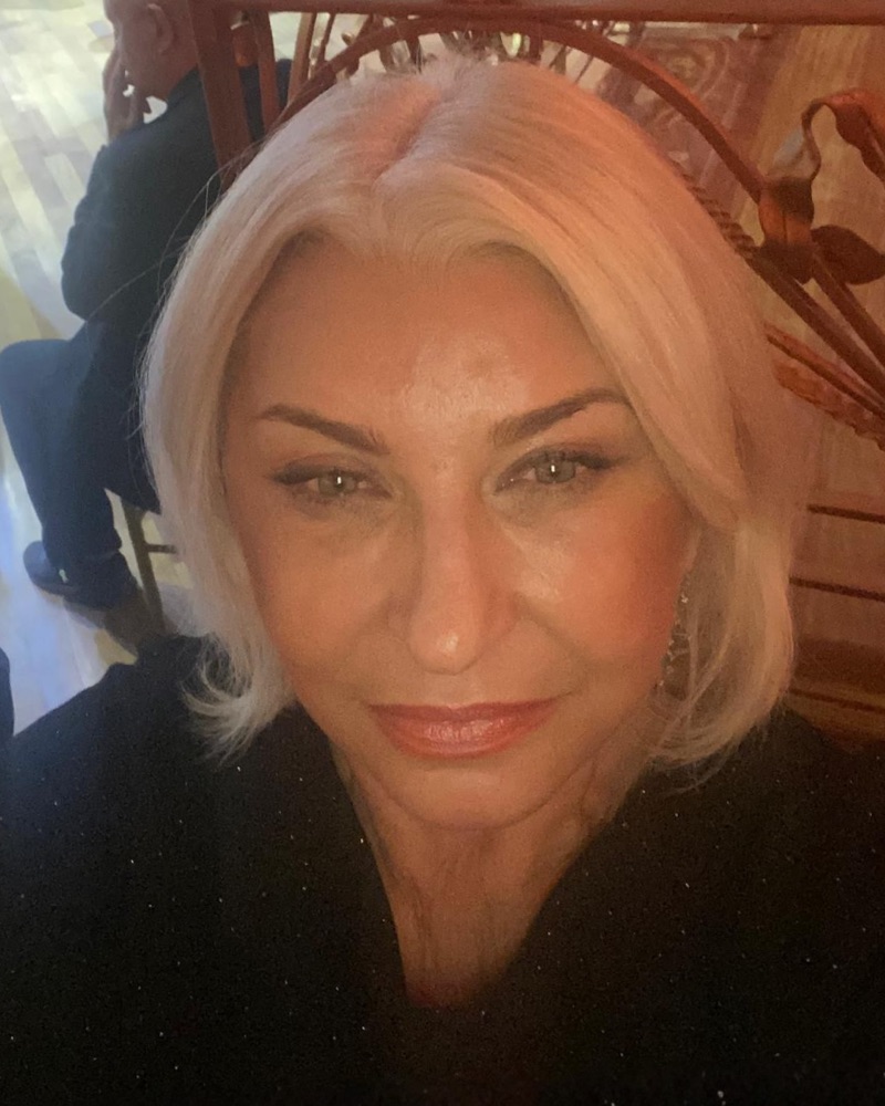 Deep plane facelift recovery at 3.5 months