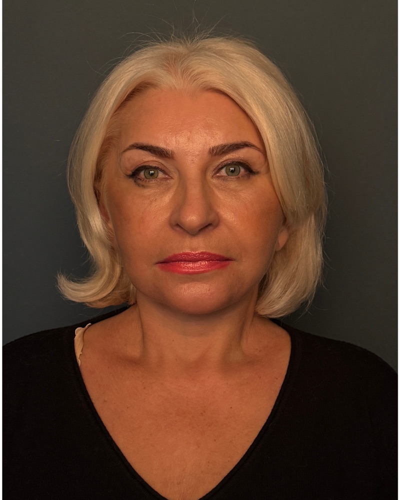 Deep plane facelift final result at 7 months