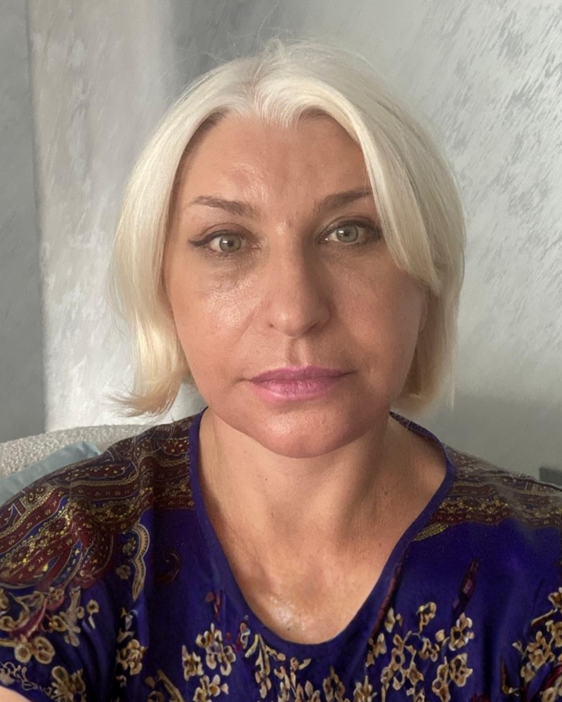 Deep plane facelift recovery at 6 weeks
